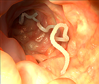Intestinal worms Causes